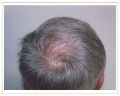 Slider image (4) ProHAIR Transplant Clinic